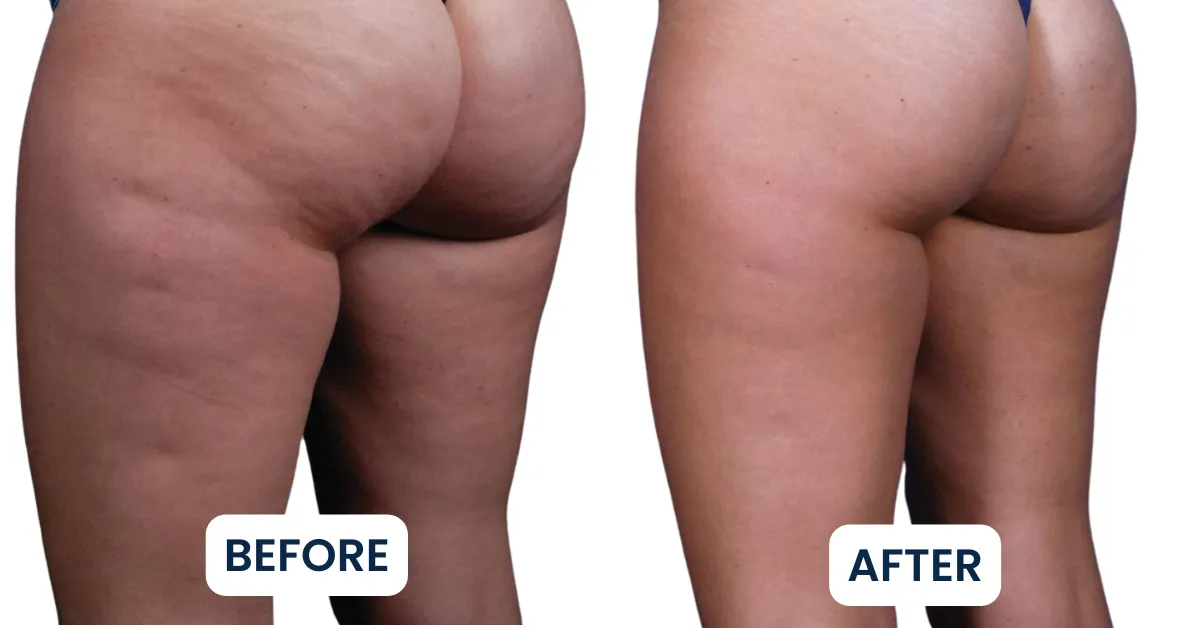Buttlift B&A (2)