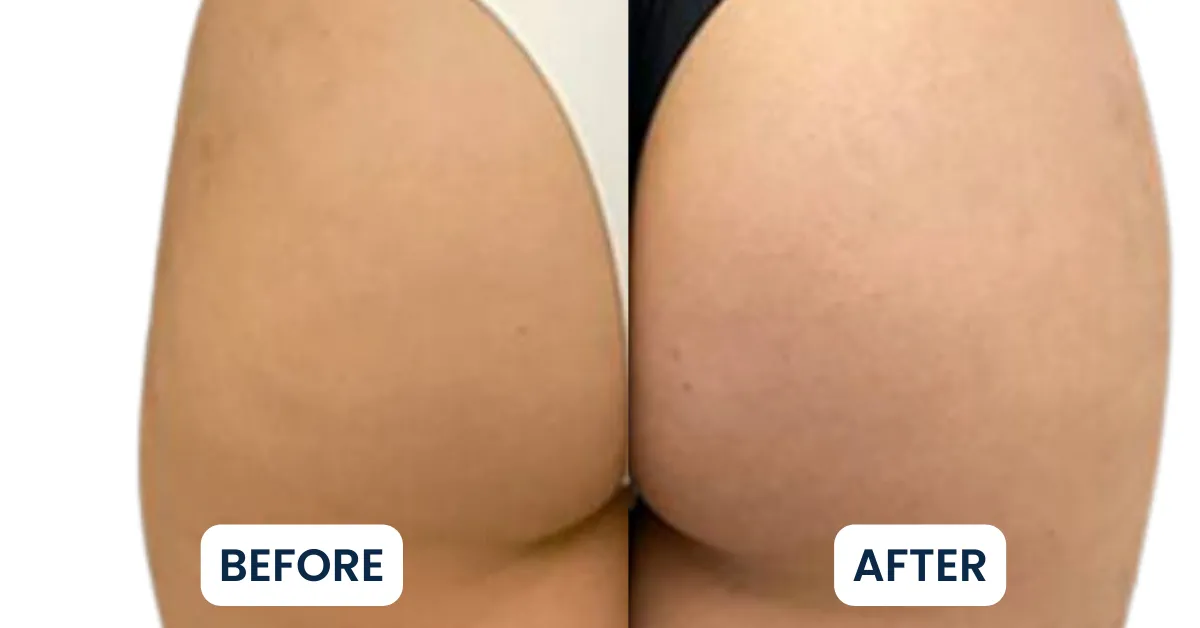 Buttlift B&A (3)