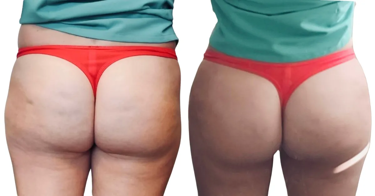 Buttlift B&A (4)