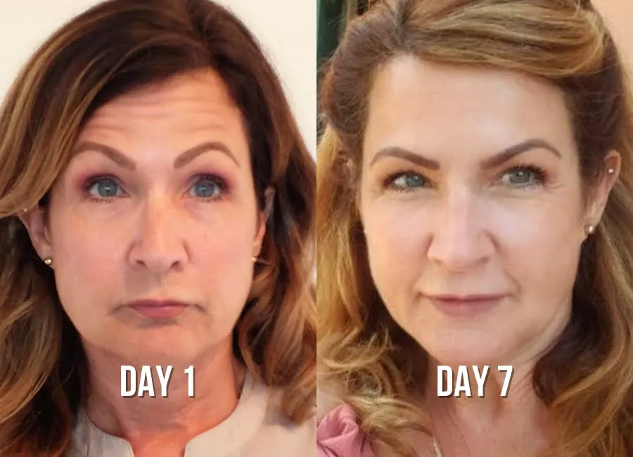 forehead-lines-before-after-5-img