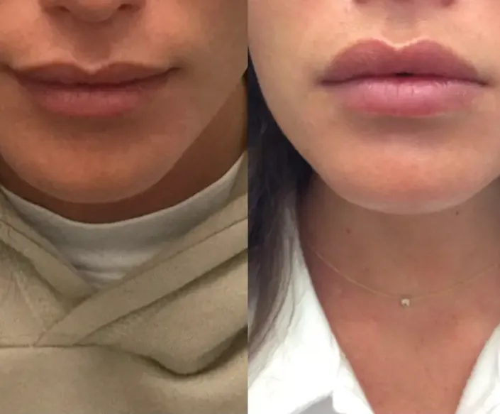 lip-flip2-img