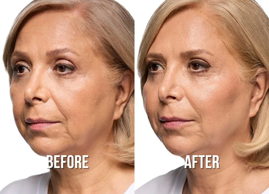 marionette-lines-before-after-1-img
